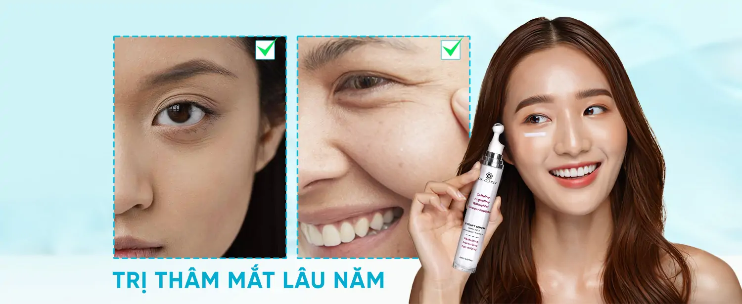 Trị Thâm Mắt Lâu Năm - Giải Pháp Dưỡng Sáng Và Cải Thiện Vùng Mắt